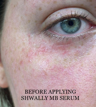 NEW Shwally Methylene Blue Repair Serums